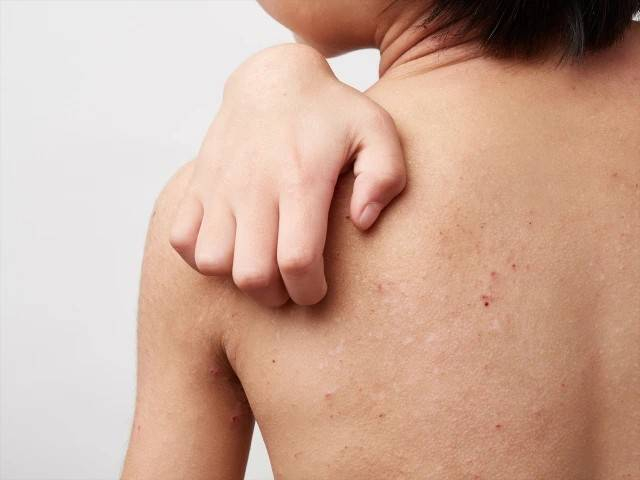 【アトピー性皮膚炎の真相】ステロイドに頼らない根本改善|肌荒れを引き起こす「3つの根本原因」と脊椎調整